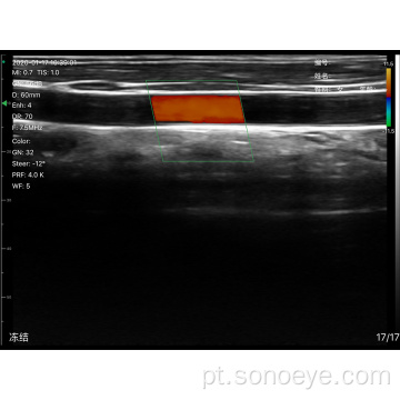 Scanner de ultra-som linear super largura para inspecionar mama